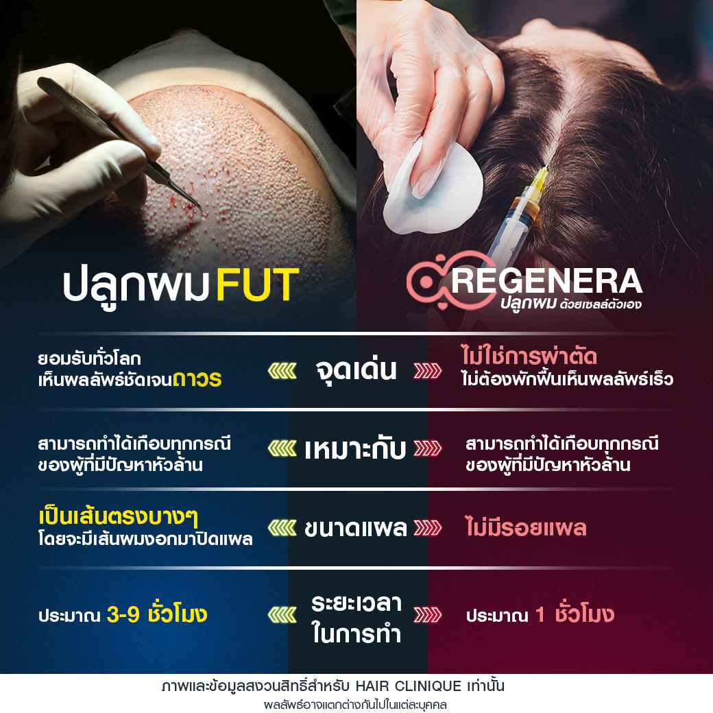 ปลูกผม FUT,Regenera activa,ปลูกผม,รีวิวปลูกผม,ผมบาง,หัวล้าน,หัวเถิก