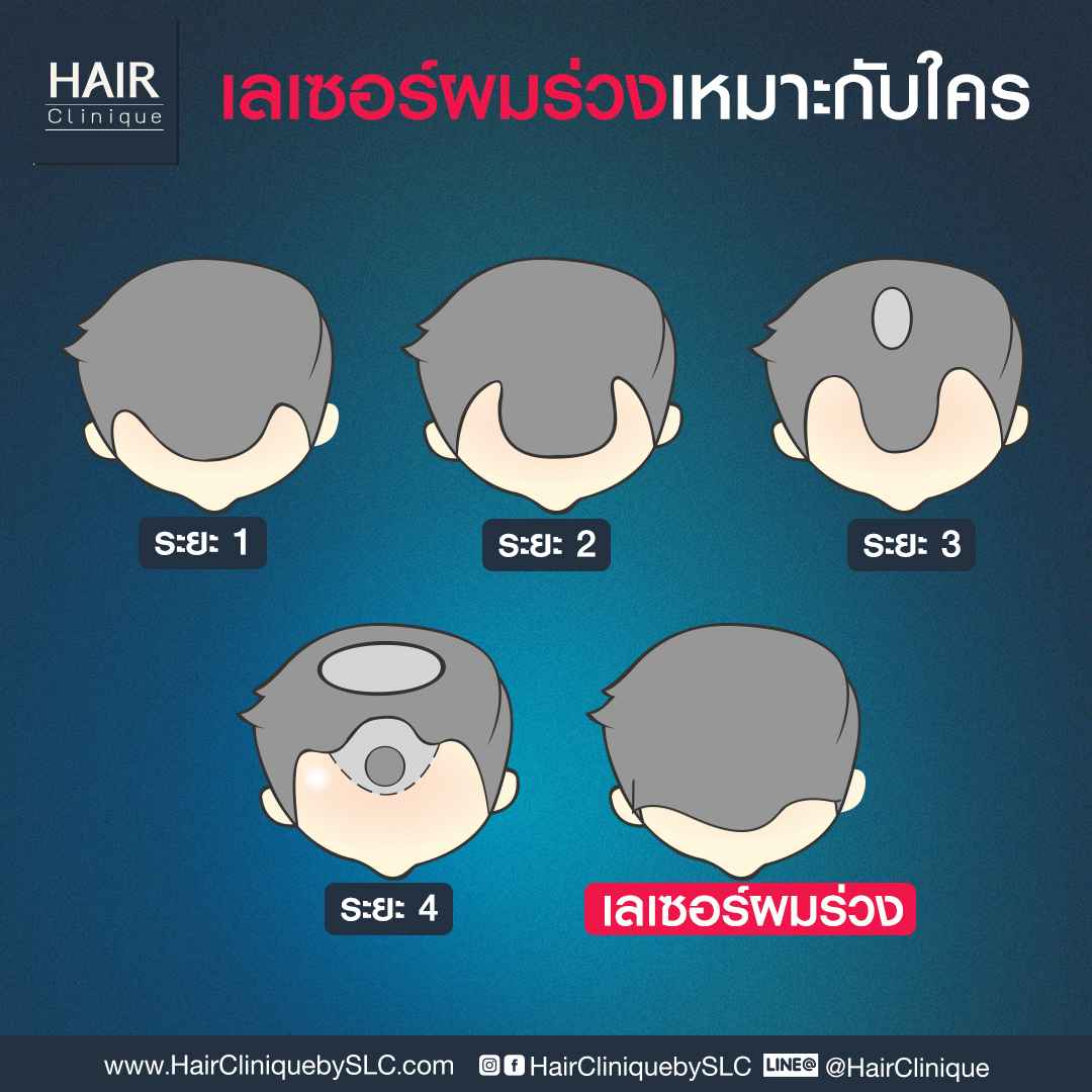 เลเซอร์ผมร่วงเหมาะกับใคร-เลเซอร์ผม-เลเซอร์ผมบาง-เลเซอร์ผมร่วง-เลเซอร์ ปลูกผม-Laser รักษาผมร่วง-Laser ผมบาง