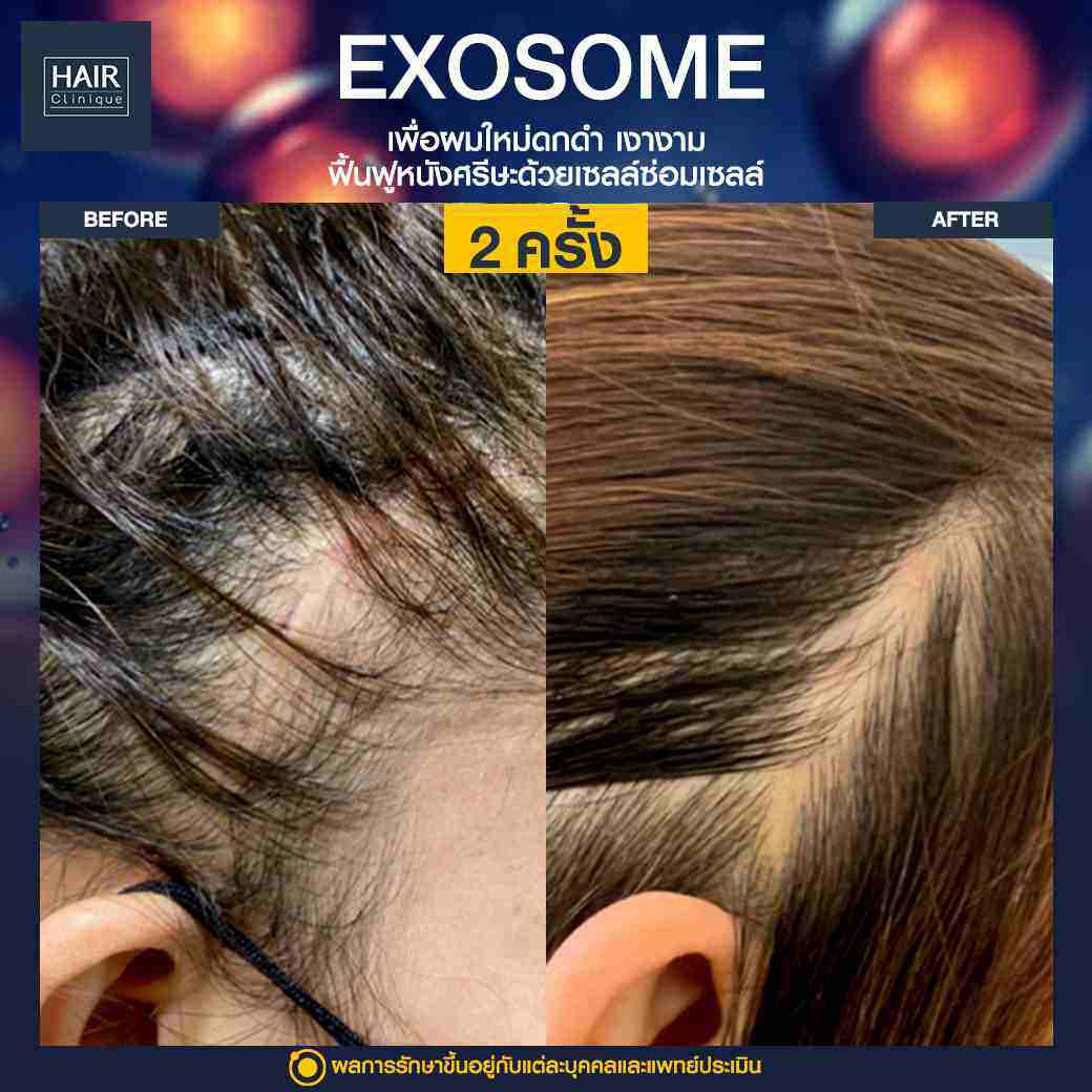 แผลเป็นบนหนังศีรษะ,รอยแผลเป็นที่หัว,ปลูกผม,รีวิวปลูกผม,ปลูกผมHairClinique,ปลูกผมSLC