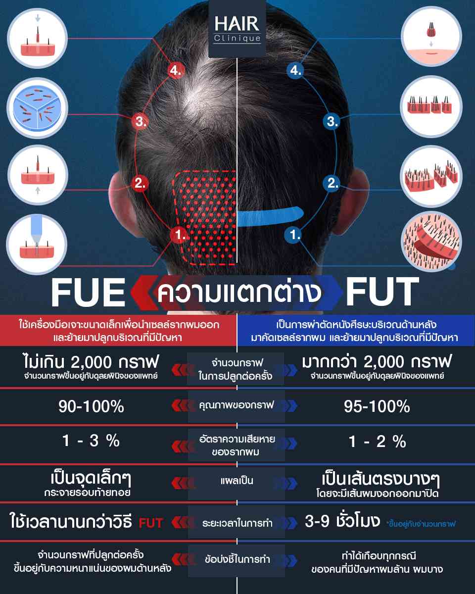 ความแตกต่างของการปลูกผม FUT และปลูกผม FUE