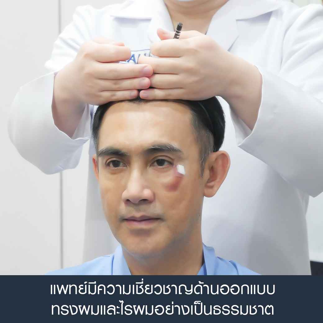 ปลูกผมที่ไหนดี, ปลูกผม hairclinique, ปลูกผม