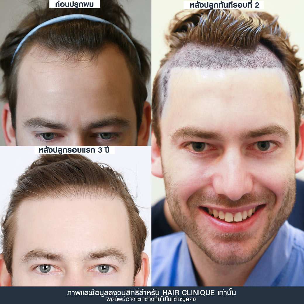 ปลูกผม,ปลูกผมรอบ 2,รีวิว ปลูกผม,ปลูกผม fut,ปลูกผม fue,ปลูกผมถาวร,ปลูกผม hair clinique,ปลูกผม slc