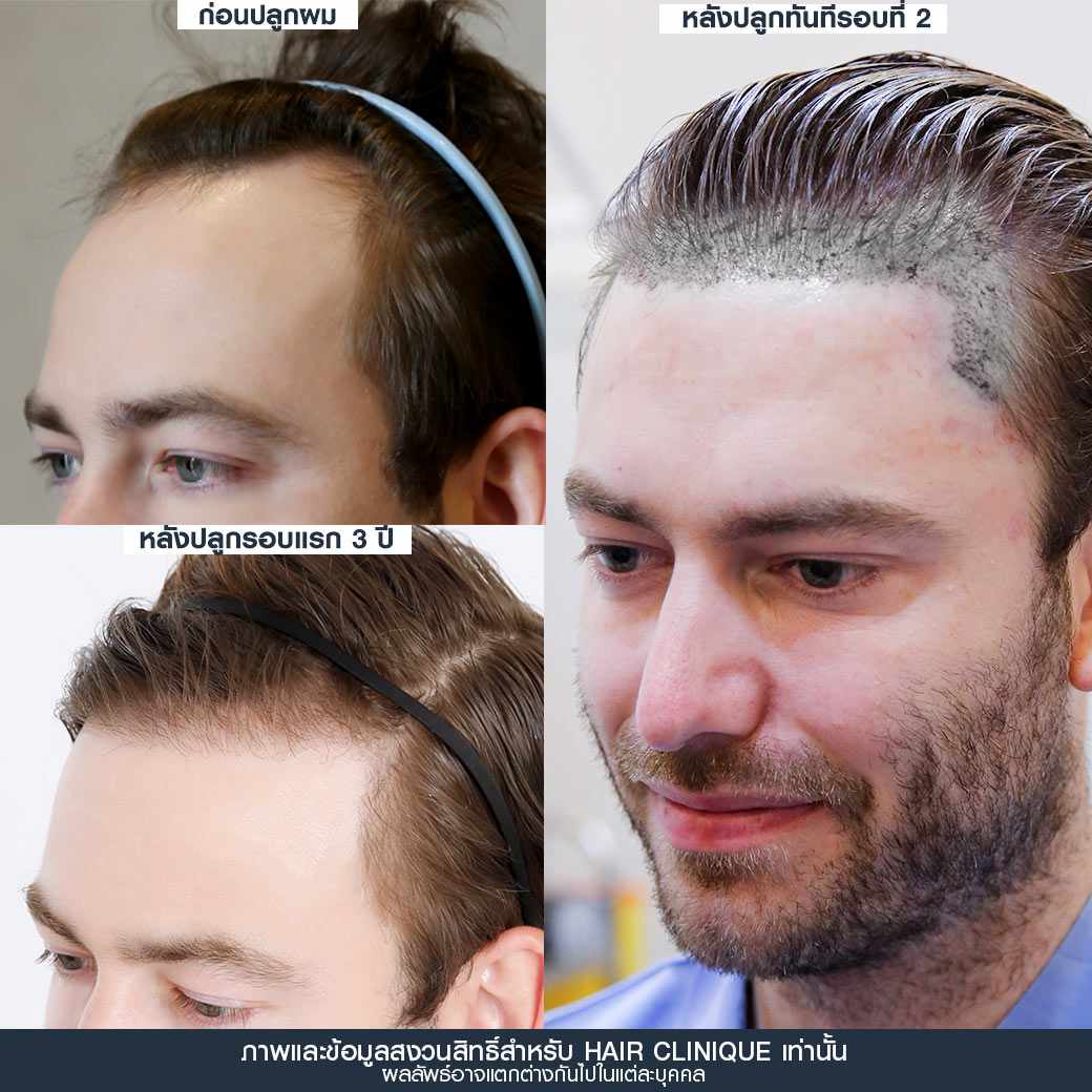 ปลูกผม,ปลูกผมรอบ 2,รีวิว ปลูกผม,ปลูกผม fut,ปลูกผม fue,ปลูกผมถาวร,ปลูกผม hair clinique,ปลูกผม slc