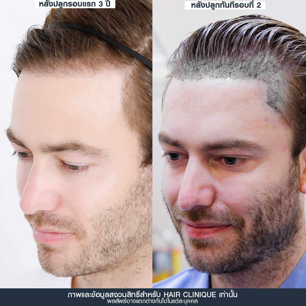ปลูกผม,ปลูกผมรอบ 2,รีวิว ปลูกผม,ปลูกผม fut,ปลูกผม fue,ปลูกผมถาวร,ปลูกผม hair clinique,ปลูกผม slc
