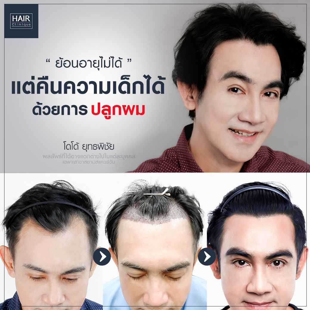 ปลูกผม,ปลููกผม fut,แพทย์อเมริกันบอร์ด,ปลูกผม Hair Clinique,รีวิวปลูกผม,รีวิวปลูกผม FUT,ผมบาง,หัวล้าน,หัวเถิก,ปลูกผมกับแพทย์อเมริกันบอร์ด,American Board of Hair Restoration Surgery,ABHRS