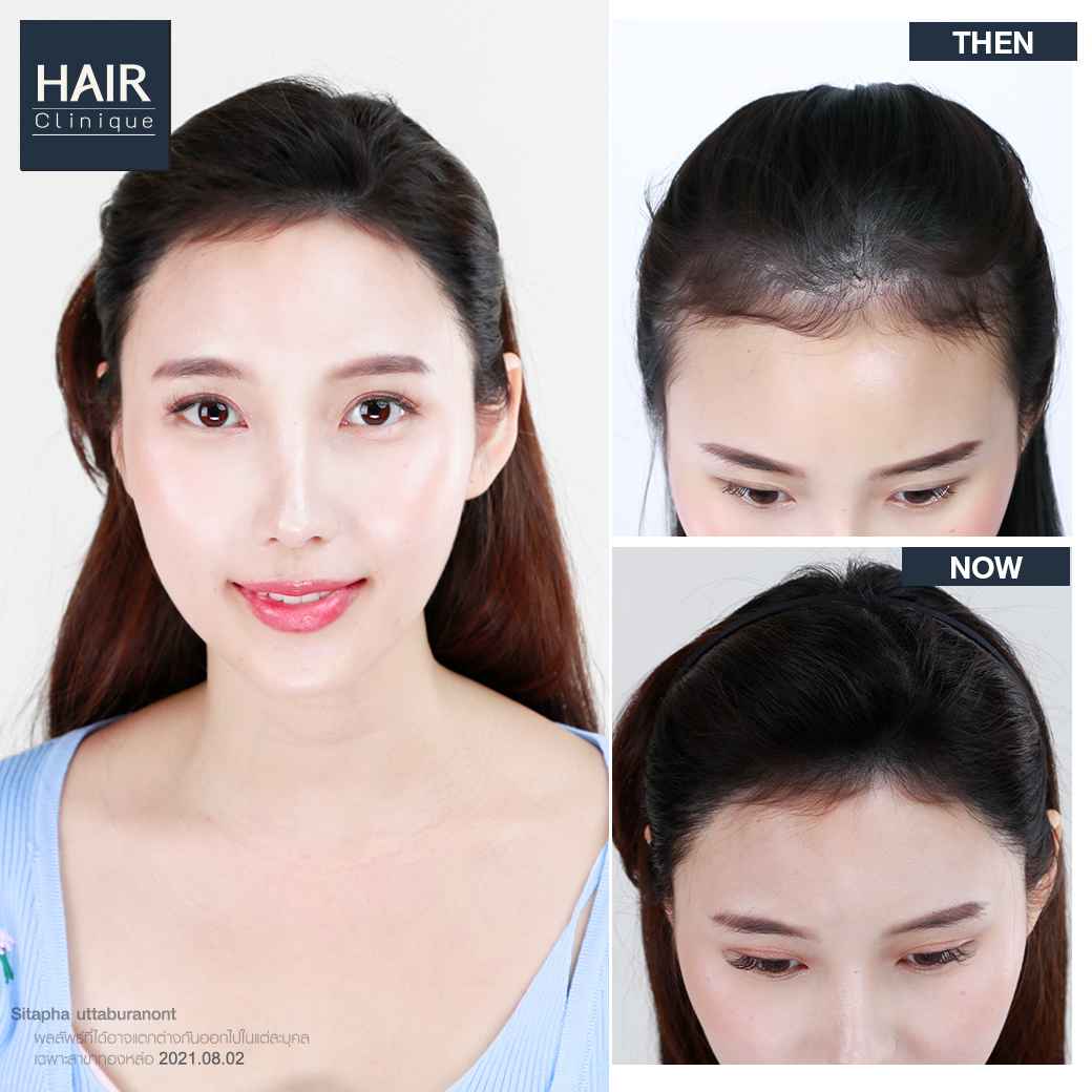 ปลูกผม,ปลููกผม fut,แพทย์อเมริกันบอร์ด,ปลูกผม Hair Clinique,รีวิวปลูกผม,รีวิวปลูกผม FUT,ผมบาง,หัวล้าน,หัวเถิก,ปลูกผมกับแพทย์อเมริกันบอร์ด,American Board of Hair Restoration Surgery,ABHRS