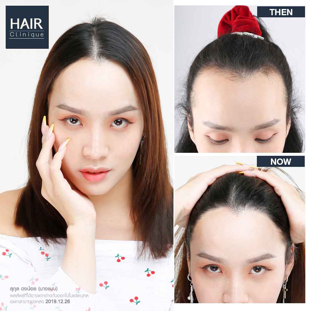 ปลูกผม,ปลููกผม fut,แพทย์อเมริกันบอร์ด,ปลูกผม Hair Clinique,รีวิวปลูกผม,รีวิวปลูกผม FUT,ผมบาง,หัวล้าน,หัวเถิก,ปลูกผมกับแพทย์อเมริกันบอร์ด,American Board of Hair Restoration Surgery,ABHRS