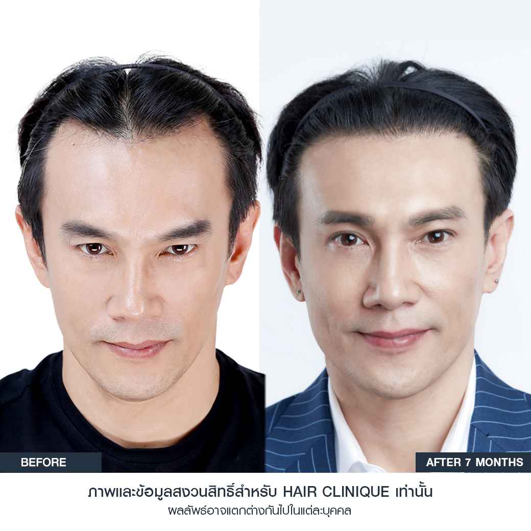 ปลูกผม,ปลููกผม fut,แพทย์อเมริกันบอร์ด,ปลูกผม Hair Clinique,รีวิวปลูกผม,รีวิวปลูกผม FUT,ผมบาง,หัวล้าน,หัวเถิก,ปลูกผมกับแพทย์อเมริกันบอร์ด,American Board of Hair Restoration Surgery,ABHRS