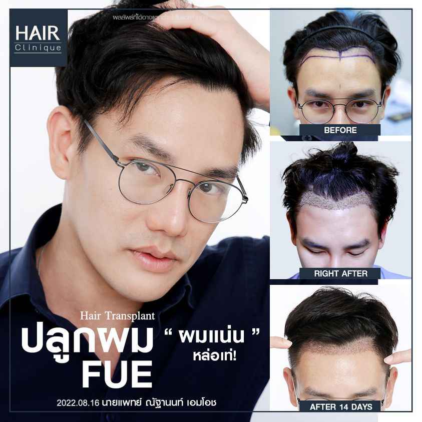 คลินิกปลูกผม,ปลูกผม,ข้อควรรู้,เลือกคลินิกปลูกผม,รีวิวปลูกผม,ปลูกผม Hair Clinique by SLC,ปลูกผม Hair Clinique,ปลูกผมที่ไหนดี,ปลูกผม FUE,ปลูกผม FUT