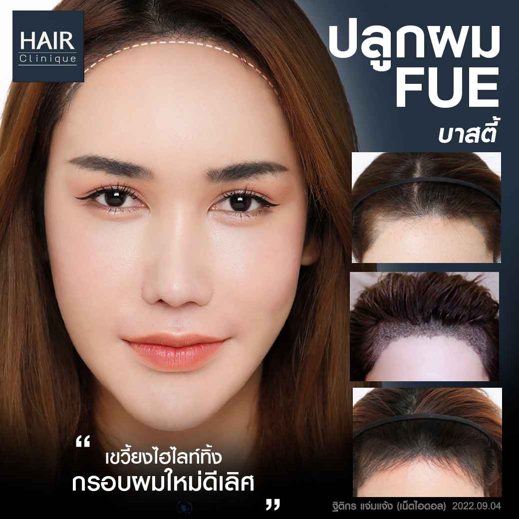 คลินิกปลูกผม,ปลูกผม,ข้อควรรู้,เลือกคลินิกปลูกผม,รีวิวปลูกผม,ปลูกผม Hair Clinique by SLC,ปลูกผม Hair Clinique,ปลูกผมที่ไหนดี,ปลูกผม FUE,ปลูกผม FUT