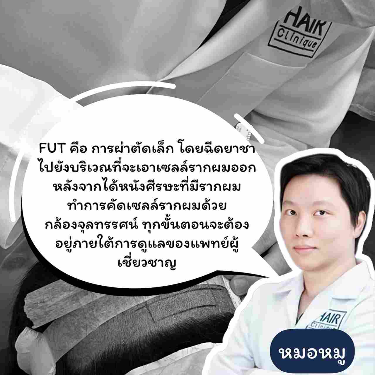 ปลูกผม,ปลูกผม fue,ปลูกผม fut,regenera activa,hair formula shot,ปลูกผม ไม่ผ่าตัด,รีวิวปลูกผม,แก้ผมบาง,แก้ผมร่วง,ปัญหาผมร่วง,ปัญหาผมบาง,ปลูกผม Hair Clinique by SLC,ปลูกผม Hair Clinique