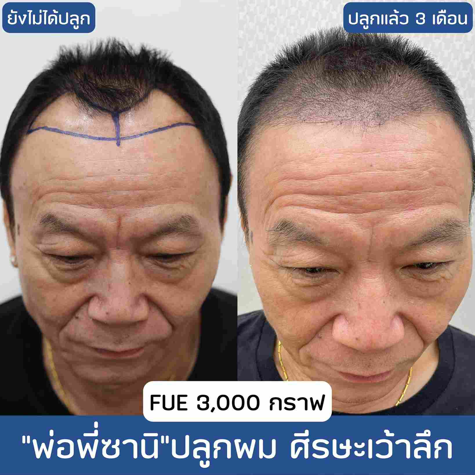 ปลูกผมผู้ชาย,ปลูกผม,รีวิวปลูกผม,ปลูกผม fut,ปลูกผม fue,รีวิวปลูกผม,รีวิวปลูกผม Hair Clinique,รีวิวปลูกผมผู้ชาย