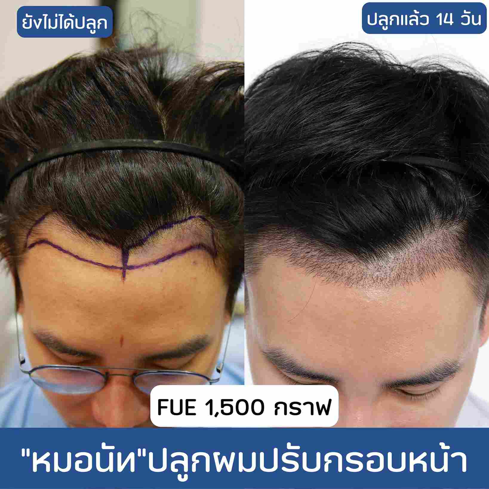 ปลูกผมผู้ชาย,ปลูกผม,รีวิวปลูกผม,ปลูกผม fut,ปลูกผม fue,รีวิวปลูกผม,รีวิวปลูกผม Hair Clinique,รีวิวปลูกผมผู้ชาย