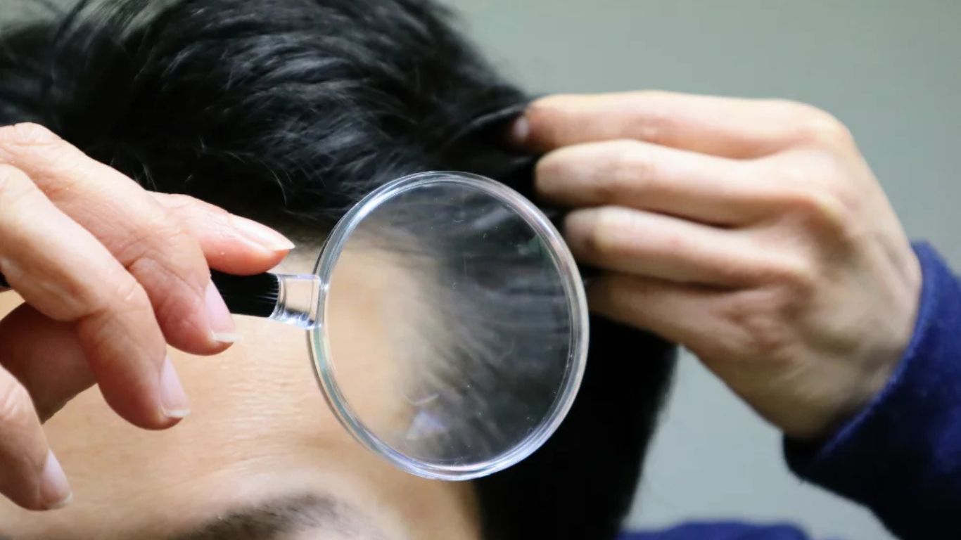ปลูกผม DHI , Hair Clinique