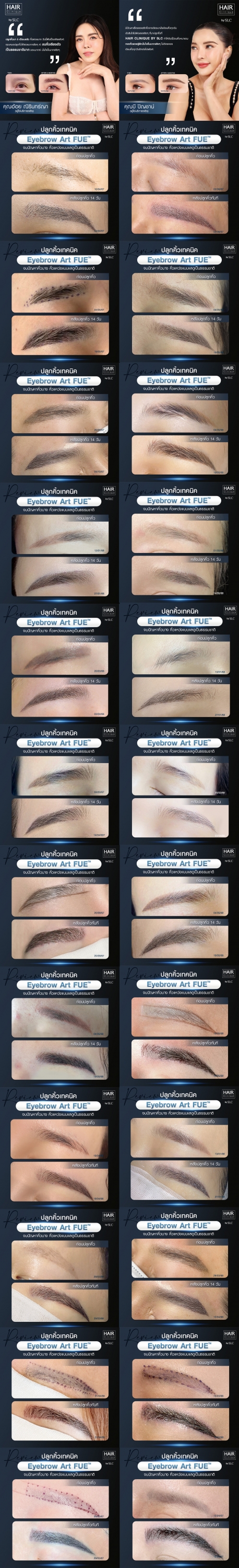 ปลูกคิ้วทรงสวย ด้วยเทคนิค Eyebrow Art FUE™ คิ้วไม่อ่อม จบปัญหาคิ้วบาง คิ้วแหว่งในราคาเริ่มต้น 19,900 บาท