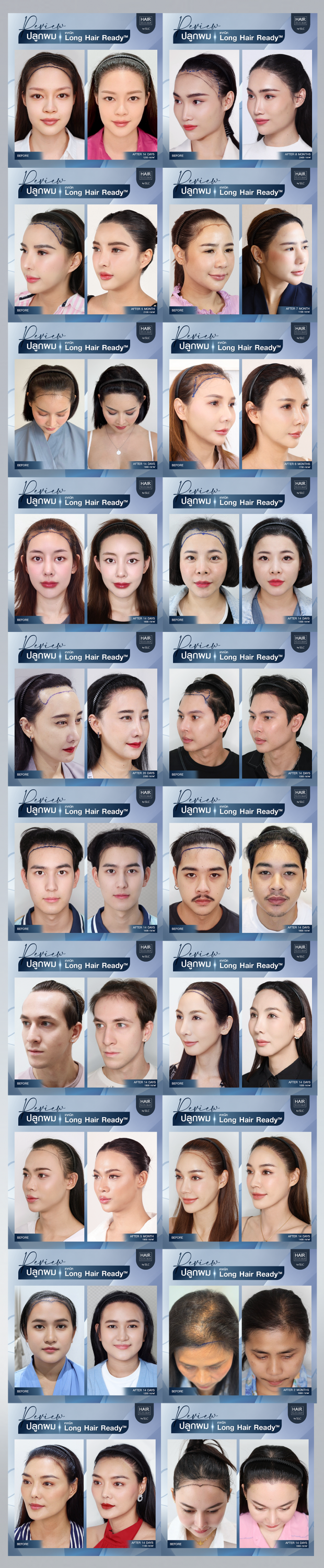 ปลูกผม, ปลูกผม Long Hair Ready™, ปลูกปุ๊บ ยาวเลย, ปลูกผมยาวไม่ต้องโกน