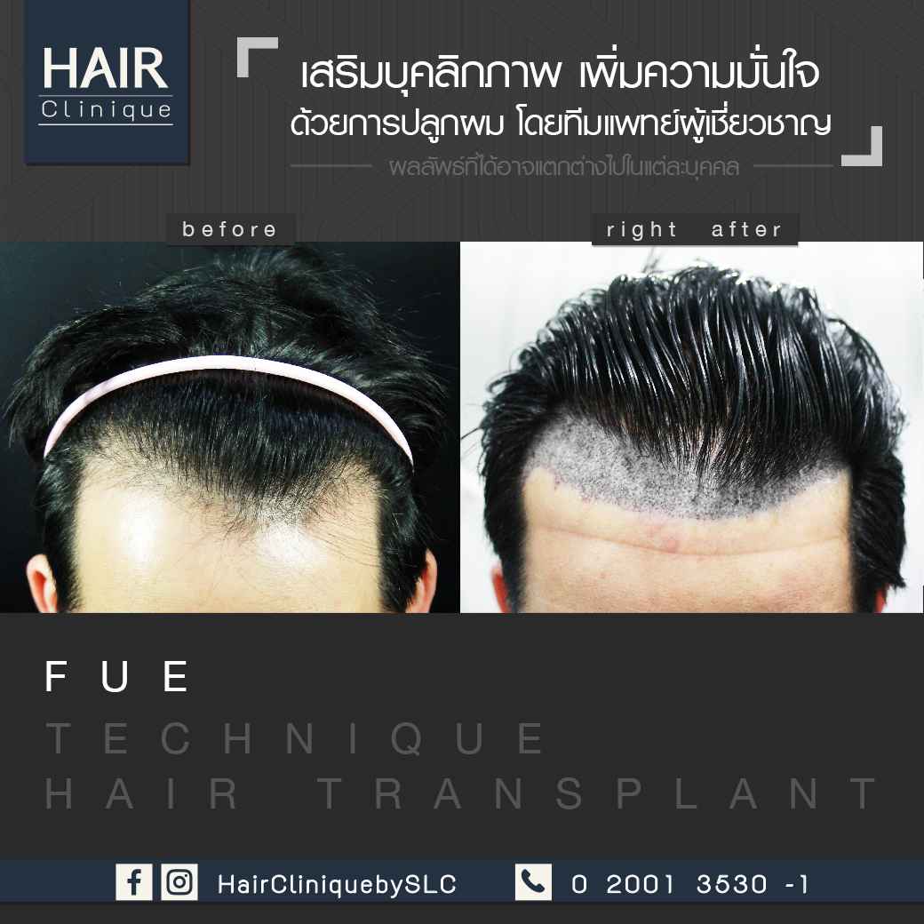 ปลูกผม,รีวิวปลูกผม,ปลูกผม fut,รีวิวปลูกผมfue,fue,hair transplant,รีวิวปลูกผมHairCliniquebySLC,รีวิวปลูกผมSLC