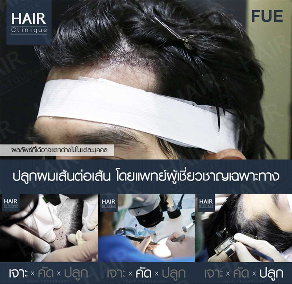 ปลูกผม-ปลูกผม fue-รีวิวปลูกผม fue-รีวิวปลูกผม