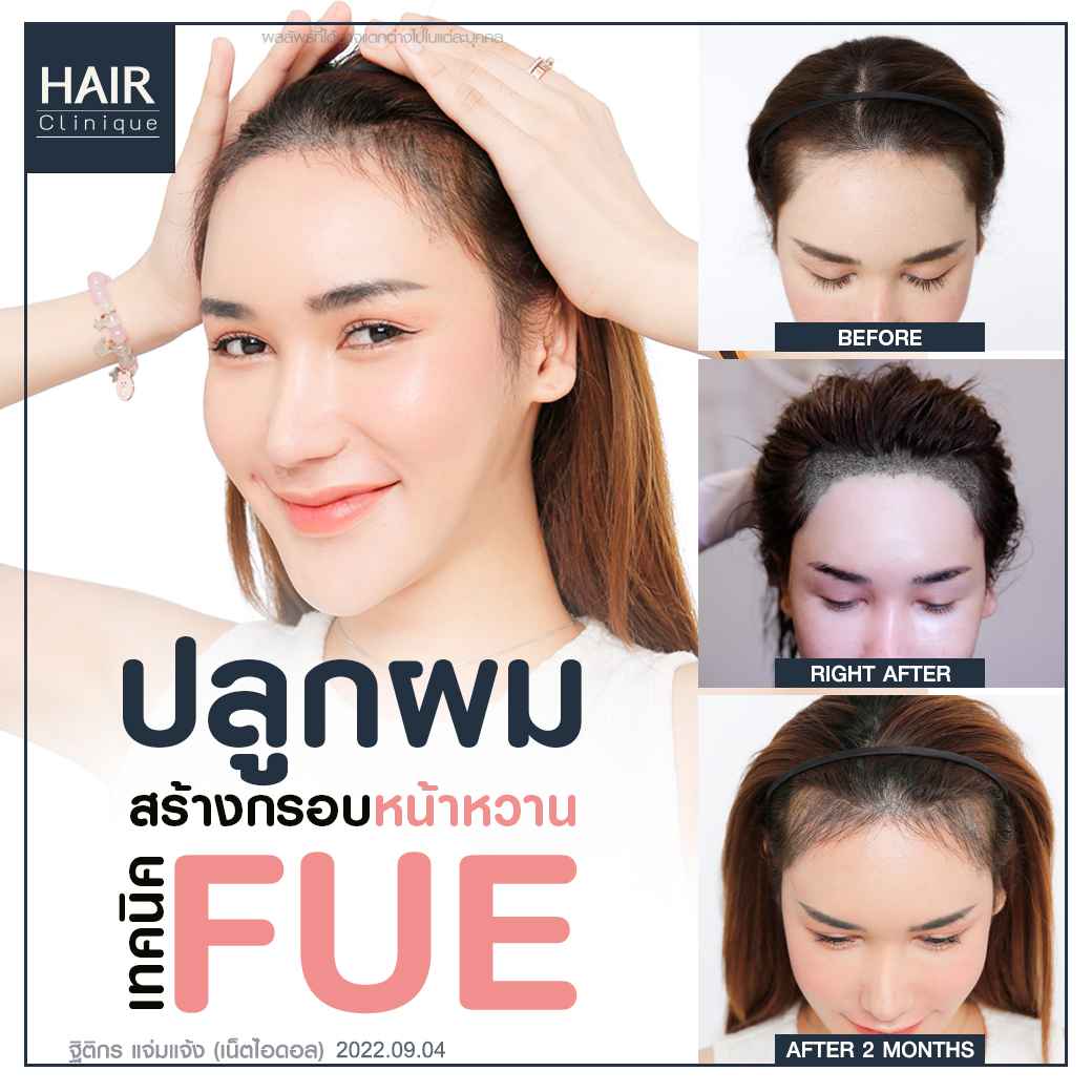 ปลูกผม,รีวิวปลูกผม,ปลูกผม fut,รีวิวปลูกผมfue,fue,hair transplant,รีวิวปลูกผมHairCliniquebySLC,รีวิวปลูกผมSLC