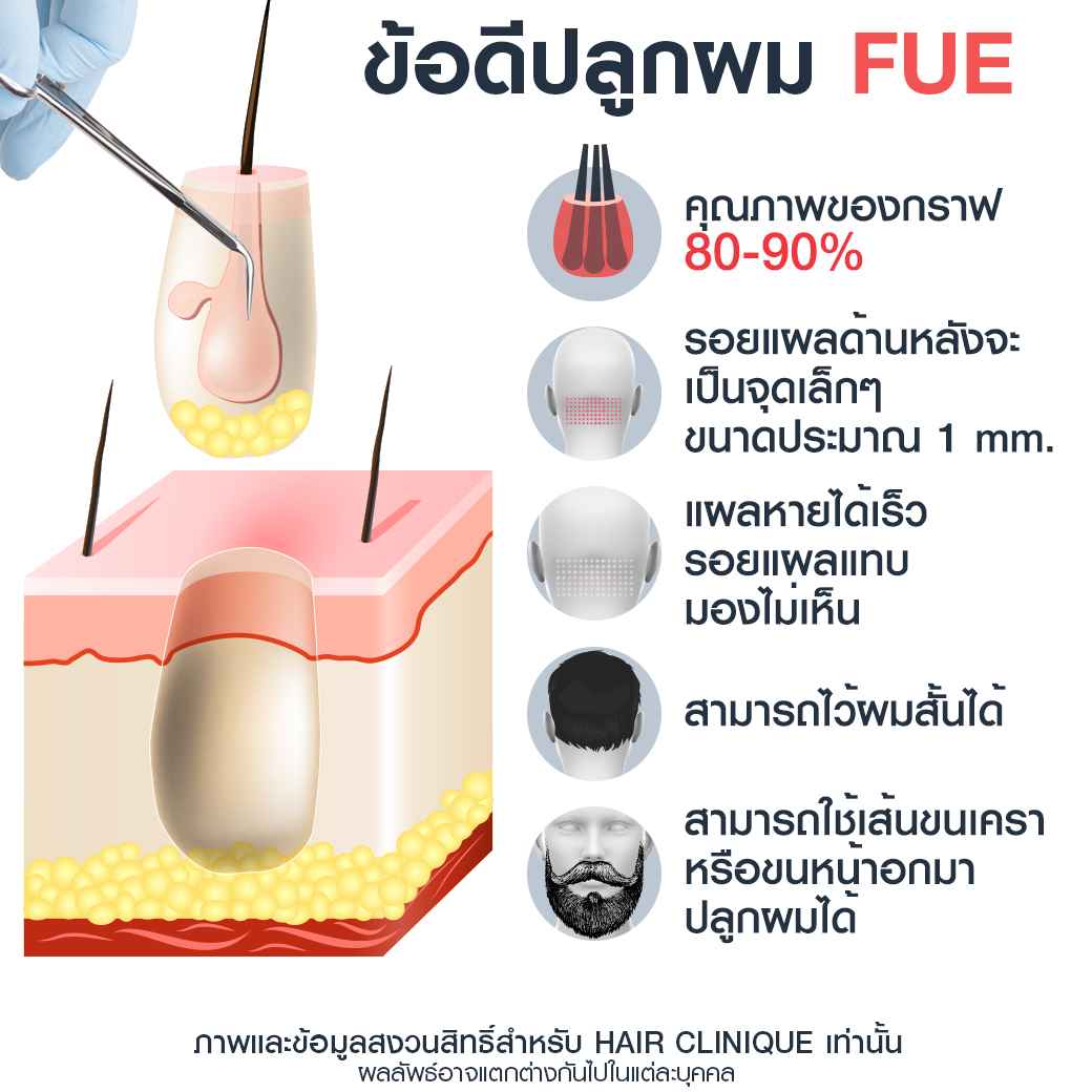 ข้อดีปลูกผม fue-ปลูกผม-ปลูกผม fue-รีวิวปลูกผม fue