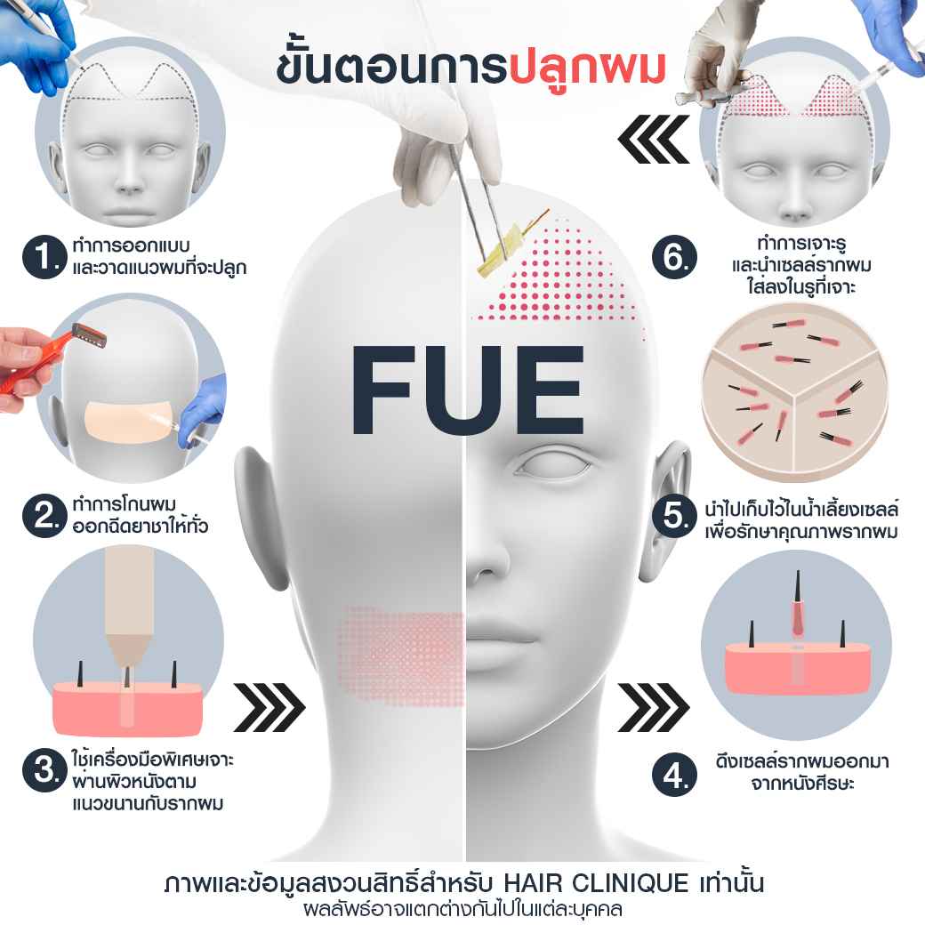 ขั้นตอนการปลูกผม fue-ปลูกผม-ปลูกผม fue-รีวิวปลูกผม fue