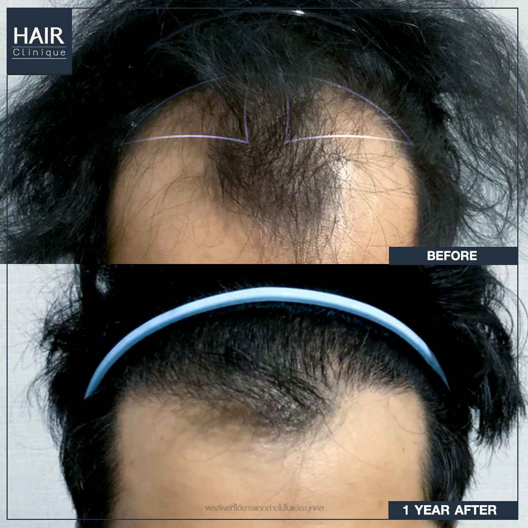 ปลูกผม,รีวิวปลูกผม,ปลูกผม fut,รีวิวปลูกผมfut,fut,hair transplant,รีวิวปลูกผมHairCliniquebySLC,รีวิวปลูกผมSLC