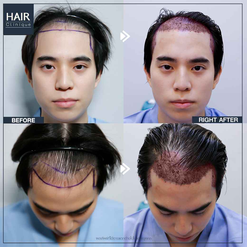 ปลูกผม,รีวิวปลูกผม,ปลูกผม fut,รีวิวปลูกผมfut,fut,hair transplant,รีวิวปลูกผมHairCliniquebySLC,รีวิวปลูกผมSLC