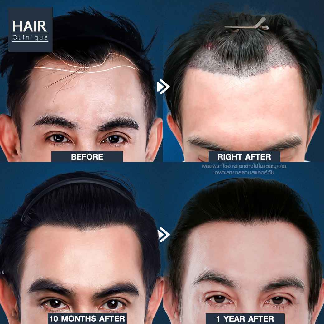 ปลูกผม,รีวิวปลูกผม,ปลูกผม fut,รีวิวปลูกผมfut,fut,hair transplant,รีวิวปลูกผมHairCliniquebySLC,รีวิวปลูกผมSLC