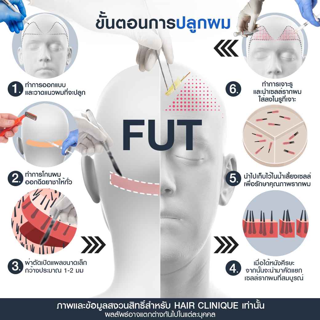 ปลูกผม,รีวิวปลูกผม,ปลูกผม fut,ขั้นตอนปลูกผมfut