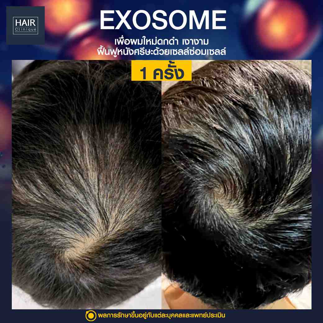 Exosome,แก้ปัญหาผมร่วง,บำรุงรากผม,ฉีดยาปลูกผม,ปลูกผมไม่ต้องผ่าตัด,ฉีดสเต็มเซลล์ผม,เอ็กโซโซม,ฉีด Exosome,ฉีดผม Exosome,นวัตกรรมช่วยหยุดผมร่วง