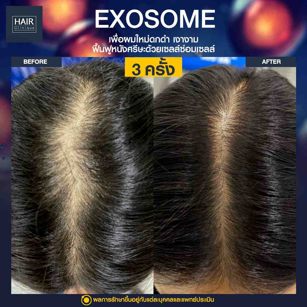 ผมร่วง,ฉีด Exosome,แก้ปัญหาผมร่วง,รีวิวฉีดExosome