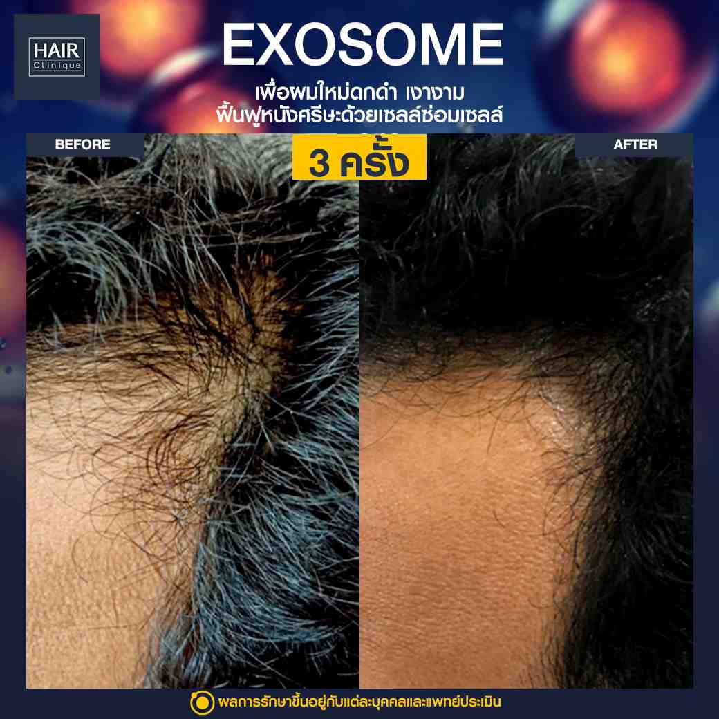 Exosome,แก้ปัญหาผมร่วง,บำรุงรากผม,ฉีดยาปลูกผม,ปลูกผมไม่ต้องผ่าตัด,ฉีดสเต็มเซลล์ผม,เอ็กโซโซม,ฉีด Exosome,ฉีดผม Exosome,นวัตกรรมช่วยหยุดผมร่วง