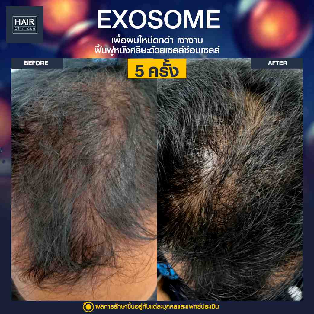 Exosome,แก้ปัญหาผมร่วง,บำรุงรากผม,ฉีดยาปลูกผม,ปลูกผมไม่ต้องผ่าตัด,ฉีดสเต็มเซลล์ผม,เอ็กโซโซม,ฉีด Exosome,ฉีดผม Exosome,นวัตกรรมช่วยหยุดผมร่วง