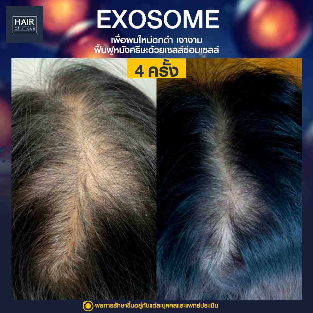 ผมร่วง คีโม, ผมร่วง, Exosome ผมร่วง, ฉีด Exosome, ฉายแสง led, ฉายแสงลดผมร่วง, แก้ปัญหาผมร่วง