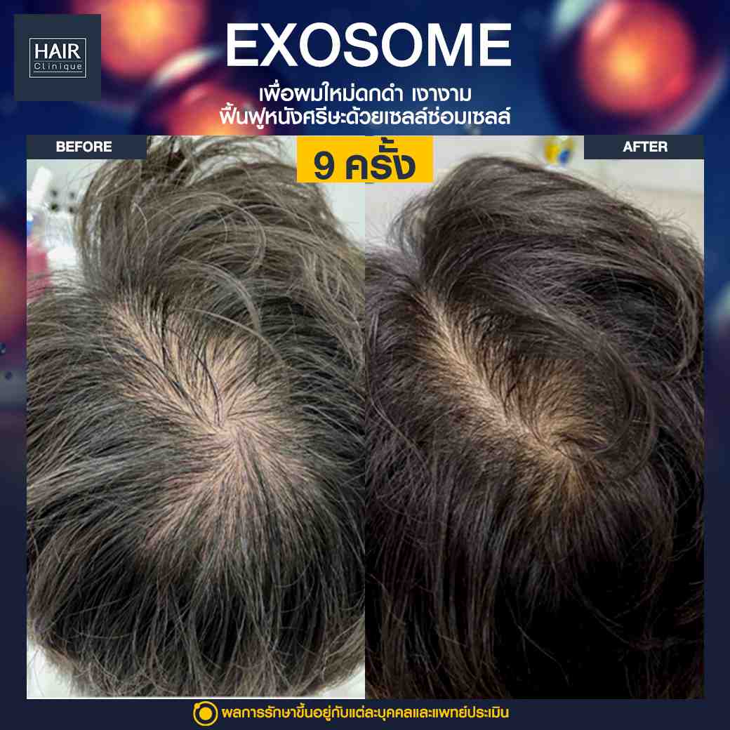 ผมร่วง,ฉีด Exosome,แก้ปัญหาผมร่วง,รีวิวฉีดExosome