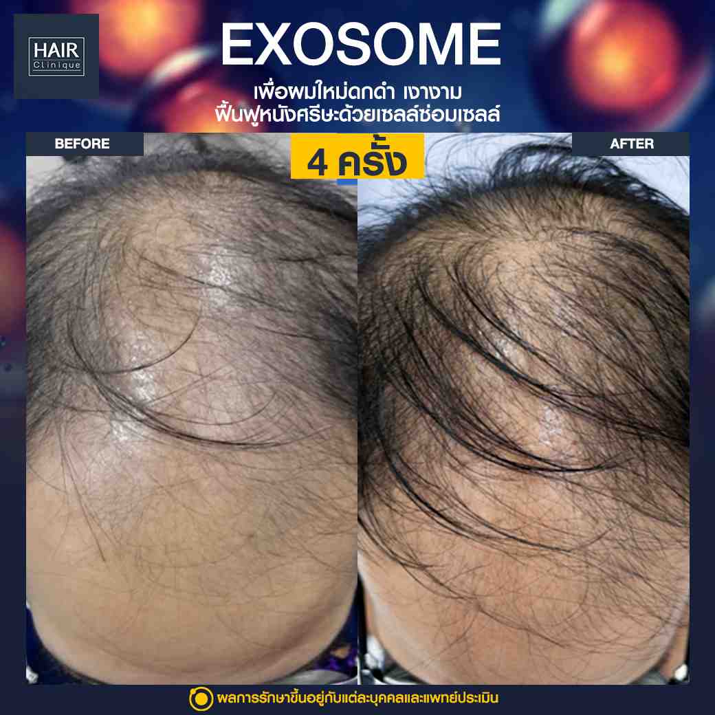 Exosome,แก้ปัญหาผมร่วง,บำรุงรากผม,ฉีดยาปลูกผม,ปลูกผมไม่ต้องผ่าตัด,ฉีดสเต็มเซลล์ผม,เอ็กโซโซม,ฉีด Exosome,ฉีดผม Exosome,นวัตกรรมช่วยหยุดผมร่วง