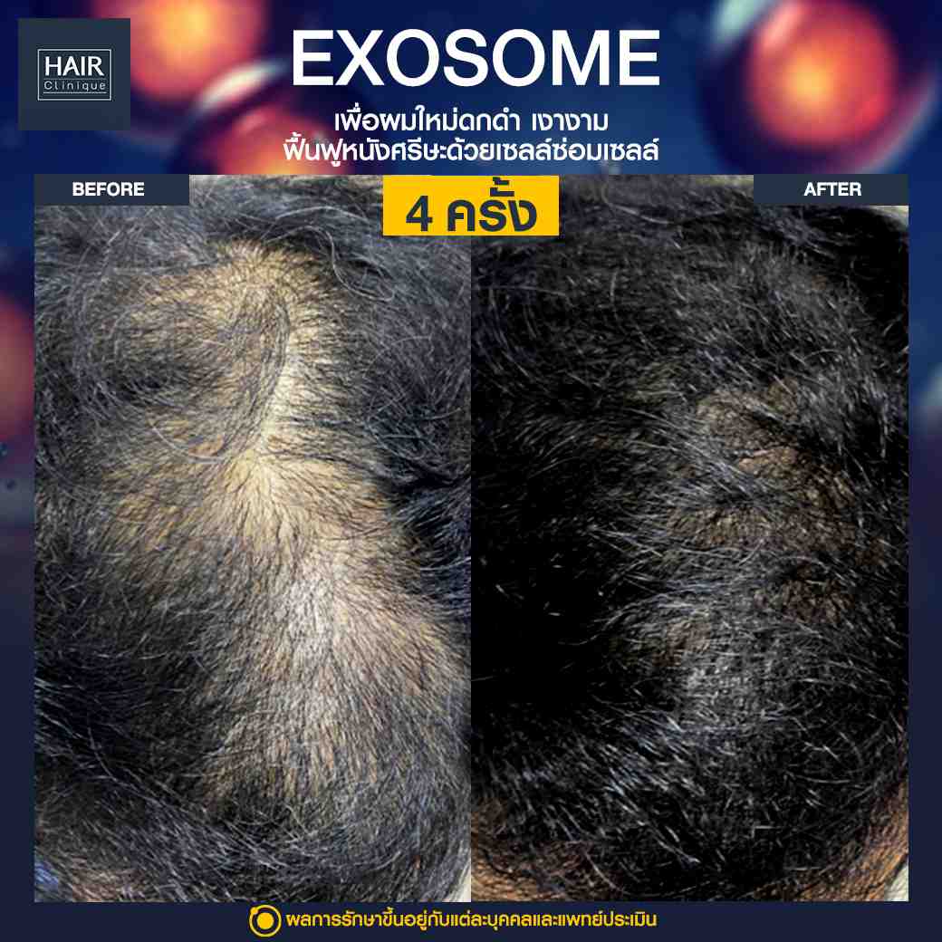 Exosome,แก้ปัญหาผมร่วง,บำรุงรากผม,ฉีดยาปลูกผม,ปลูกผมไม่ต้องผ่าตัด,ฉีดสเต็มเซลล์ผม,เอ็กโซโซม,ฉีด Exosome,ฉีดผม Exosome,นวัตกรรมช่วยหยุดผมร่วง