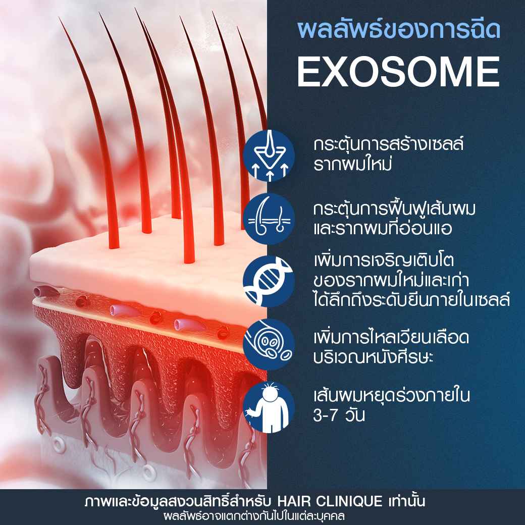 ผลลัพธ์Exosome-ฉีดExosome-ปลูกผมไม่ผ่าตัด-ฉีดยาปลูกผม-ExosomeSLC-