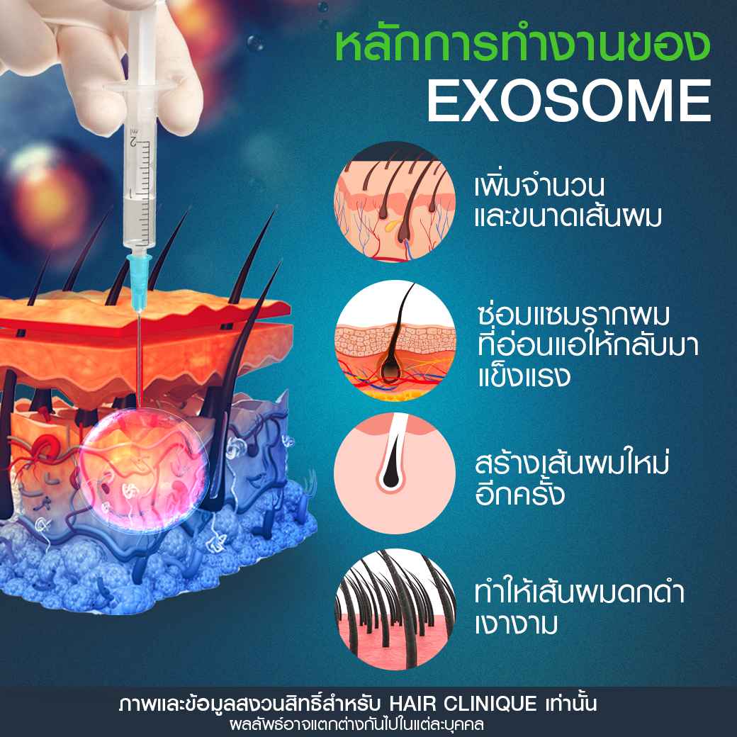 หลักการทำงานExosome,ผมร่วง,ฉีด Exosome,ฉายแสง led,ฉายแสงลดผมร่วง,แก้ปัญหาผมร่วง,รีวิวฉีดExosome,รีวิวฉายแสง led,