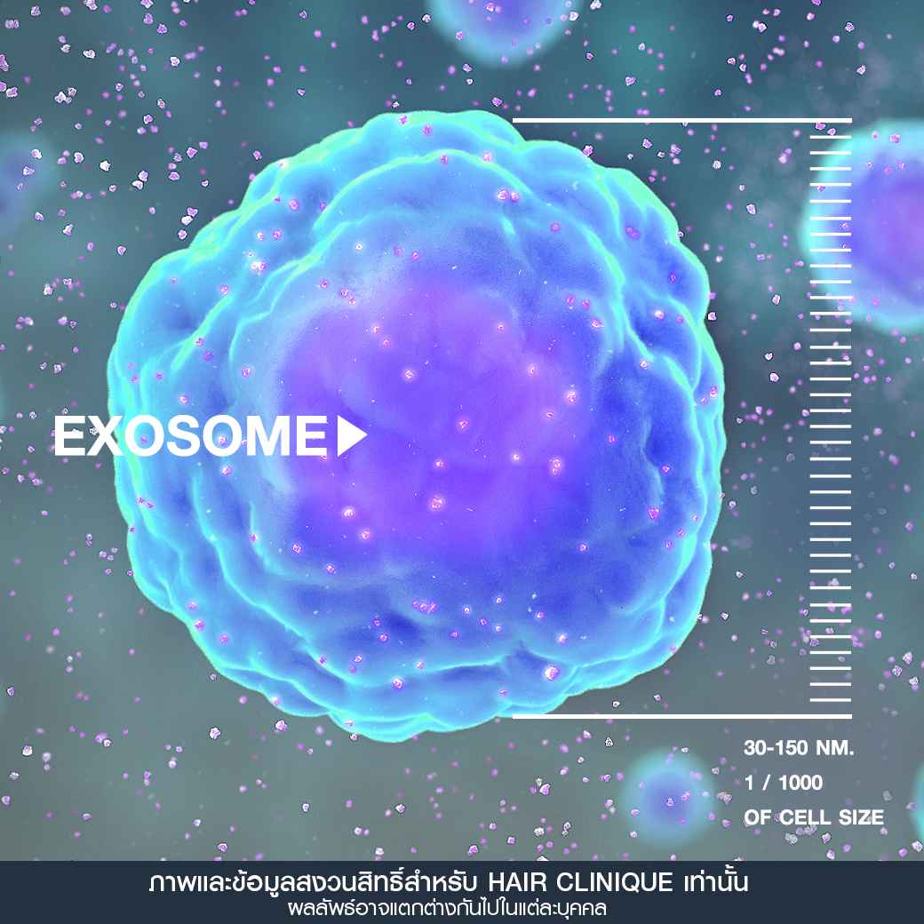 Exosome,ปลูกผมไม่ต้องผ่าตัด,ฉีด Exosome,ฉีดผม Exosome,ผมบาง,แผลเป็นบนหนังศีรษะ,รอยแผลเป็นที่หัว,ปลูกผมทับรอยแผลเป็น,รีวิวExosome