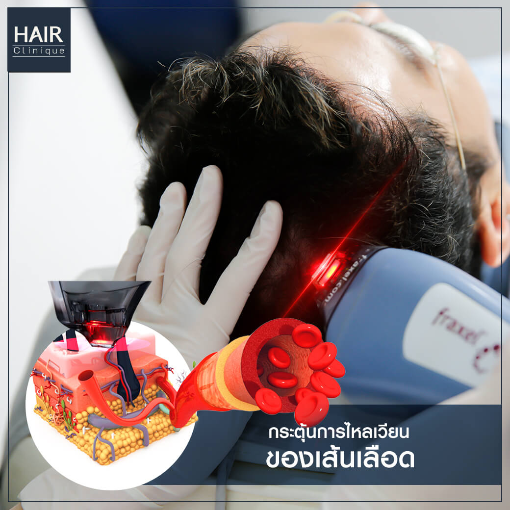 เลเซอร์ปลูกผม-รักษาผมร่วง-Hair Fraxel เลเซอร์รักษาผมร่วง-