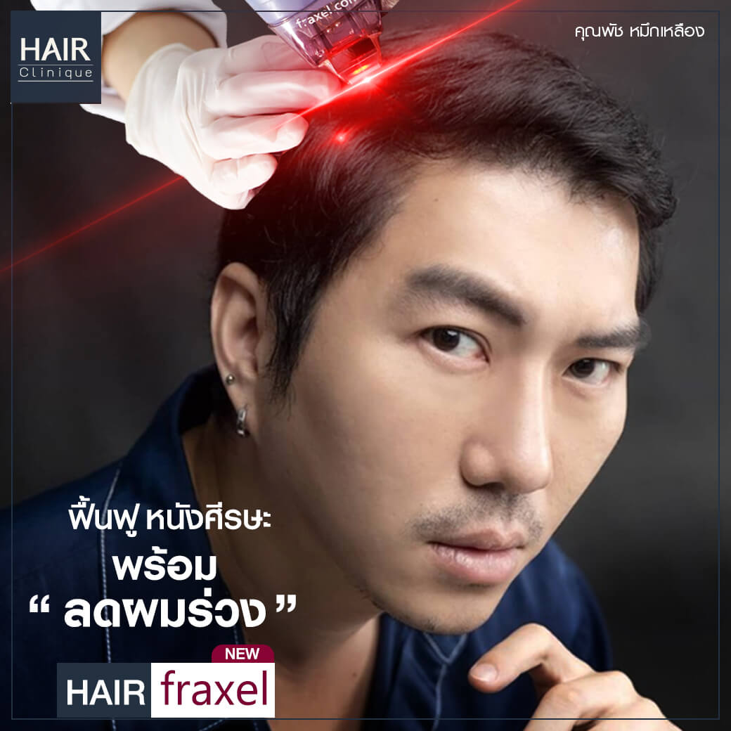 เลเซอร์ปลูกผม-รักษาผมร่วง-Hair Fraxel เลเซอร์รักษาผมร่วง-