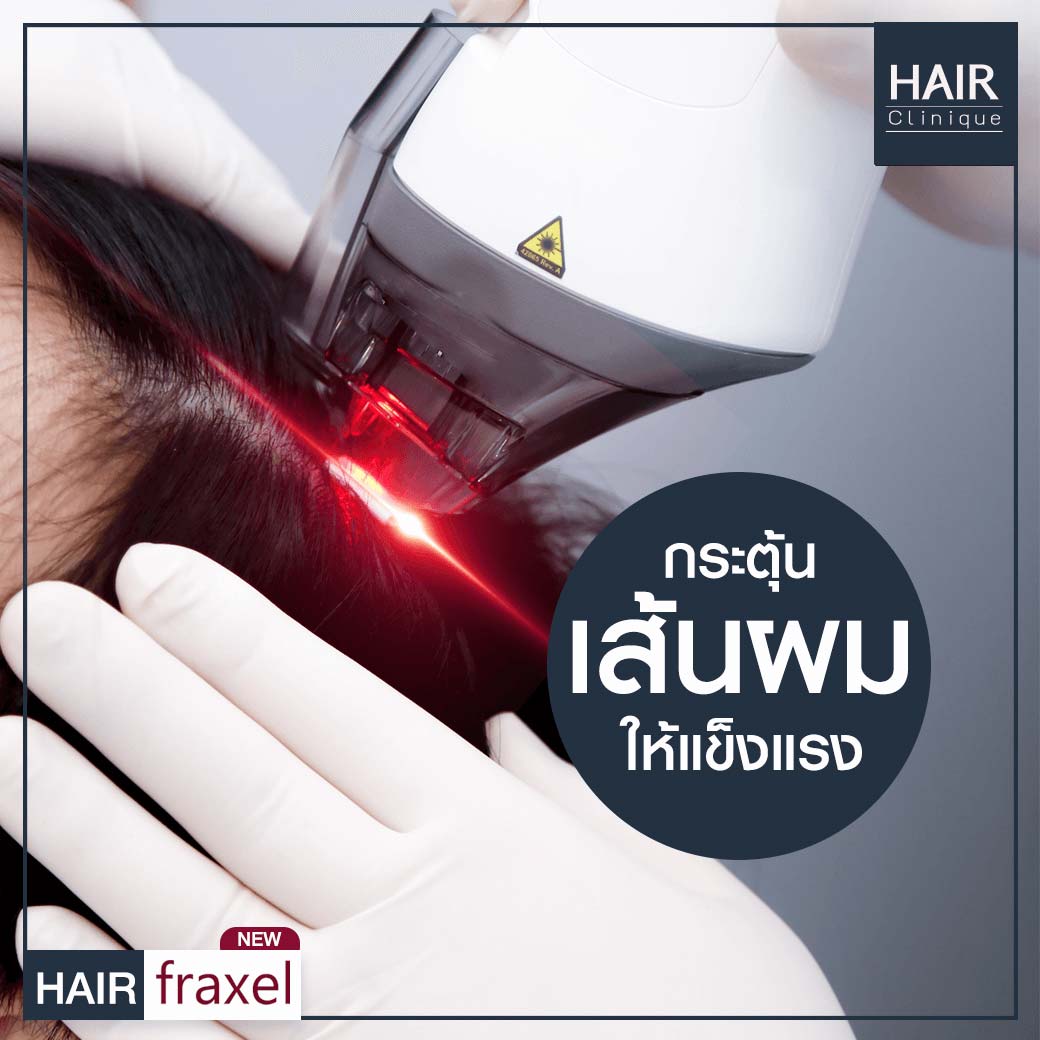 เลเซอร์ปลูกผม-รักษาผมร่วง-Hair Fraxel เลเซอร์รักษาผมร่วง-