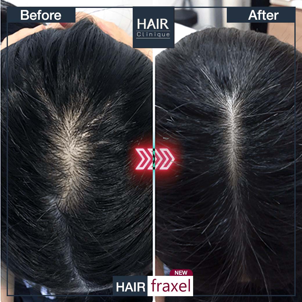 เลเซอร์ปลูกผม-รักษาผมร่วง-Hair Fraxel เลเซอร์รักษาผมร่วง-