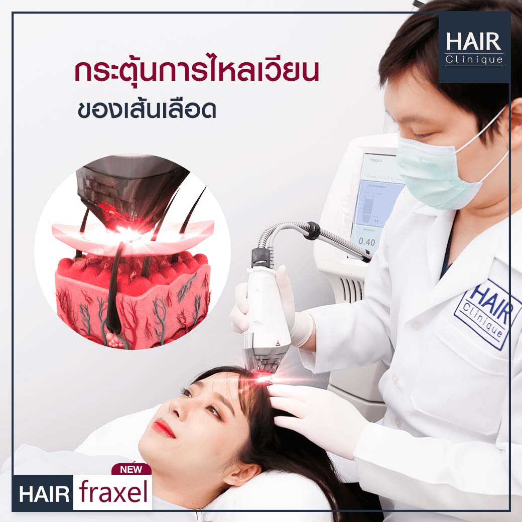 เลเซอร์ปลูกผม-รักษาผมร่วง-Hair Fraxel เลเซอร์รักษาผมร่วง-