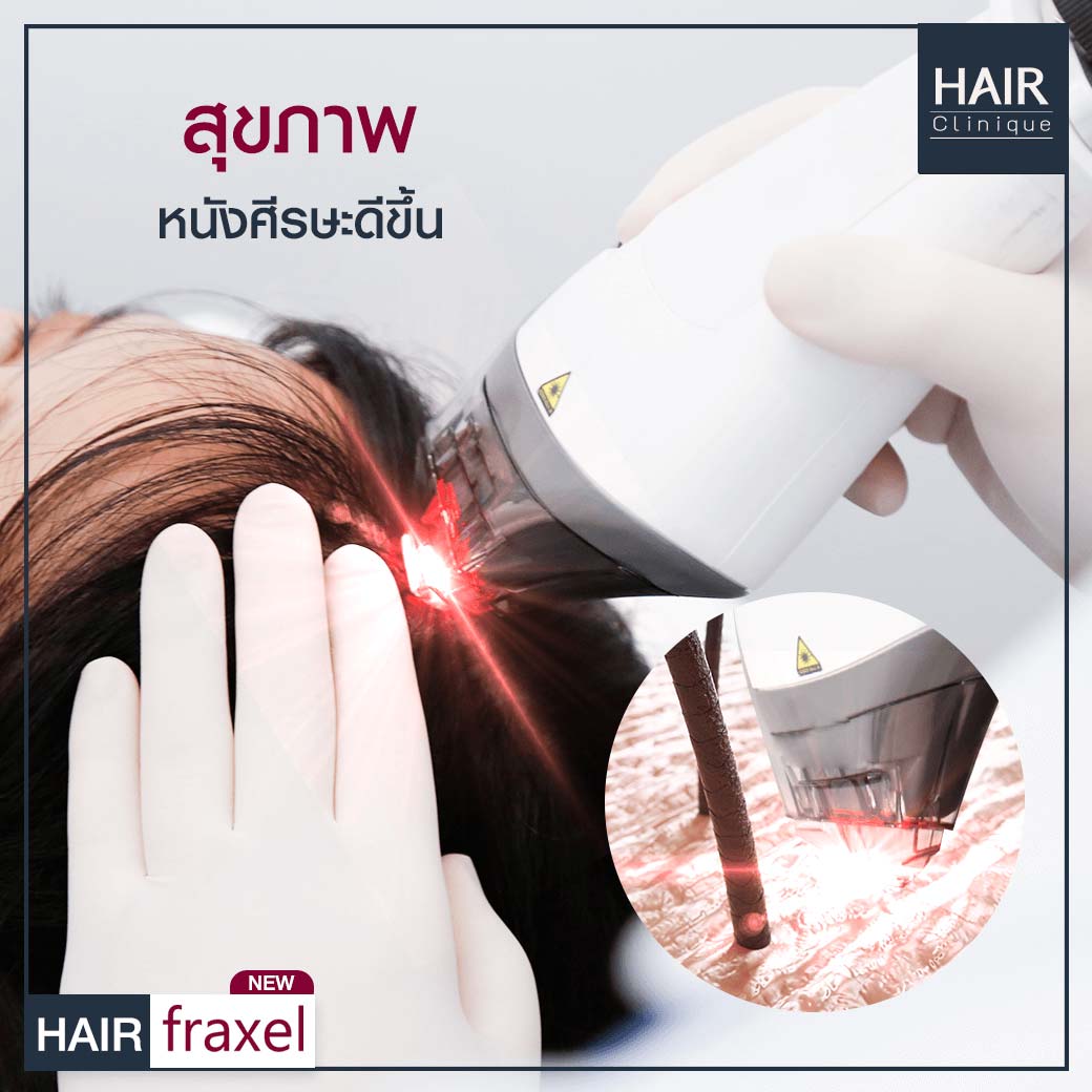 เลเซอร์ปลูกผม-รักษาผมร่วง-Hair Fraxel เลเซอร์รักษาผมร่วง-