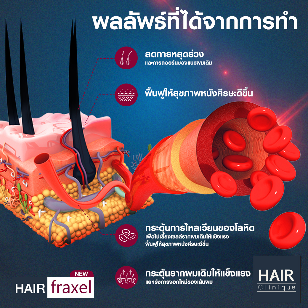 เลเซอร์ปลูกผม-รักษาผมร่วง-Hair Fraxel เลเซอร์รักษาผมร่วง  