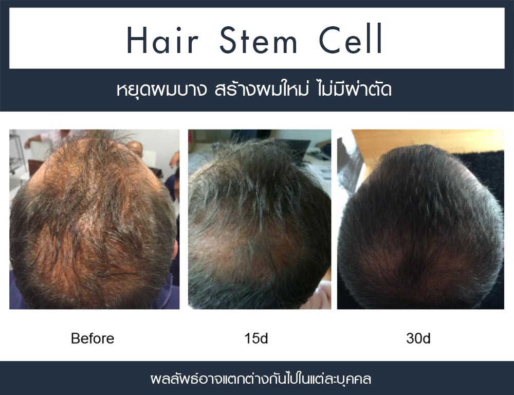 รีวิว Regenera Activa-ปลูกผมไม่ต้องผ่าตัด