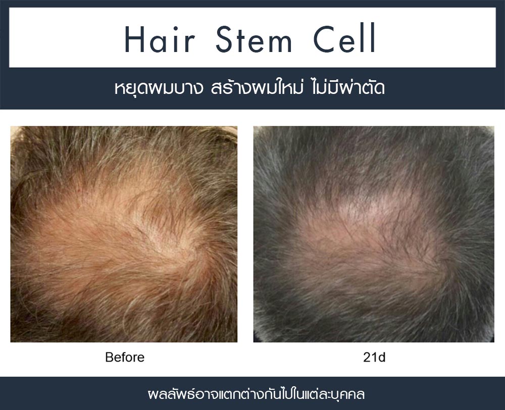 รีวิว Regenera Activa-ปลูกผมไม่ต้องผ่าตัด