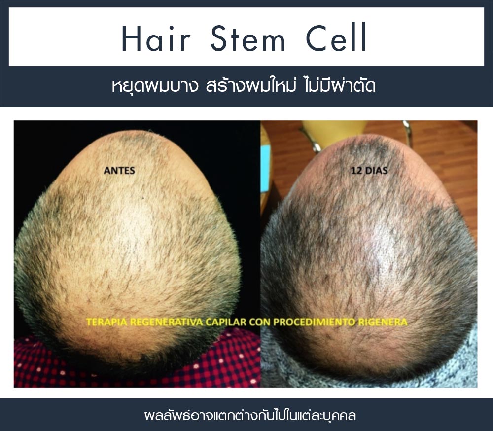 รีวิว Regenera Activa-ปลูกผมไม่ต้องผ่าตัด